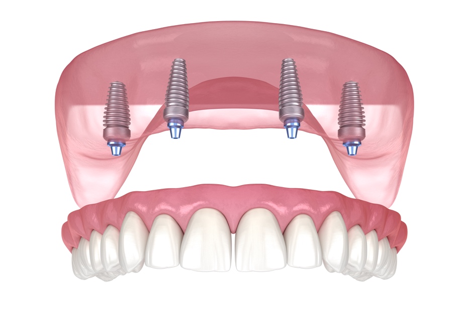 4-on-1 (i.e., Full Mouth, Full Arch, All-on-X) Dental Implant Procedures