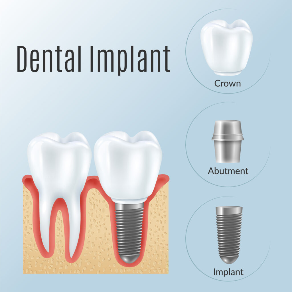 abutment teeth