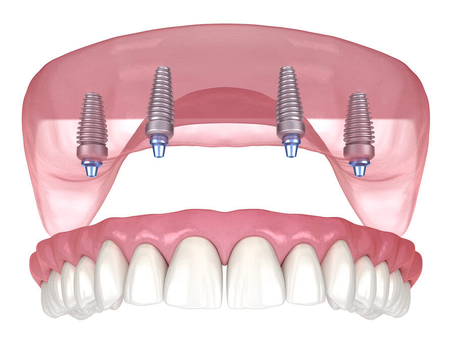 An Introduction to Full Arch Dental Implants