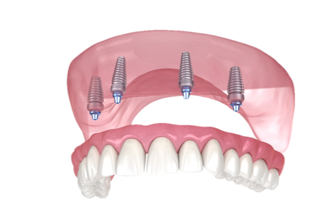 What Are Full Mouth Dental Implants?