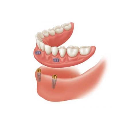 cost snap in dentures